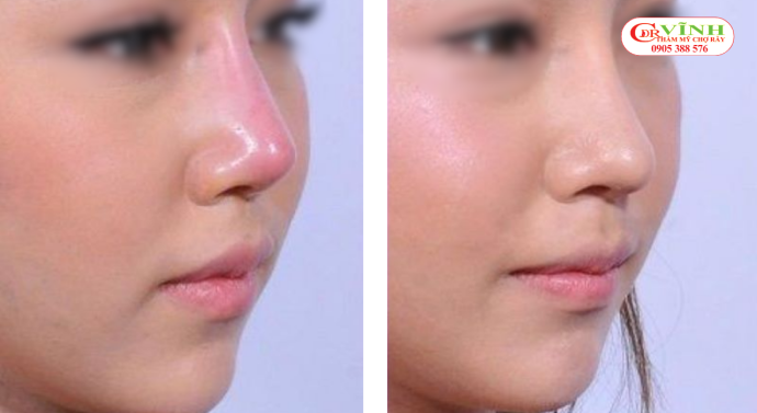 Tái tạo dáng mũi sau hỏng cần ưu tiên sự ổn định của cấu trúc và sự hài hòa với tổng thể khuôn mặt